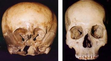 Does the Starchild skull belong to an alien ?