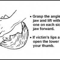 /* Figure 4-1. Jaw Thrust Method */