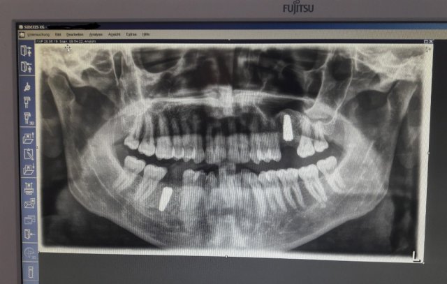 28 June 2019: panoramic radiography taken right after implant installation.