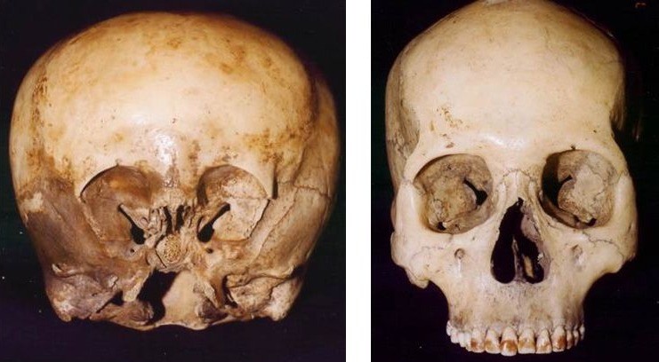 left: starchild skull; right: normal human skull