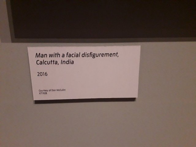 Man with a facial disfigurement, Culcutta, India