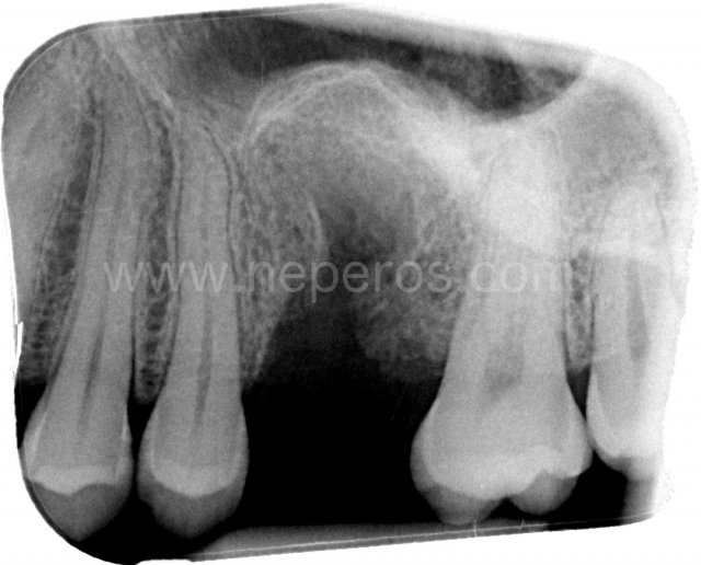 31 January 2019: tooth 26 is not there anymore.