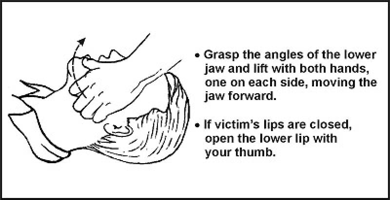 /* Figure 4-1. Jaw Thrust Method */
