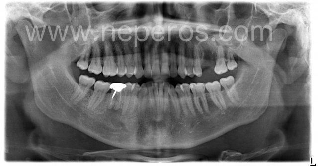 31 January 2019: panoramic radiography taken right after tooth 26 extraction.