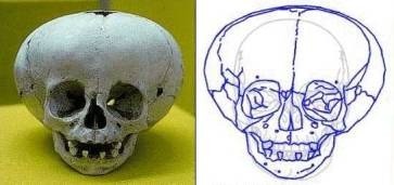 Skull of hominid discovered by anthropologist Richard Leakey in Kenya (1972)
