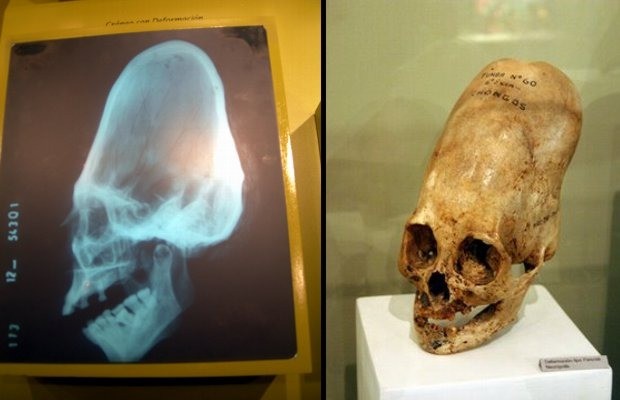 Elongated human skulls