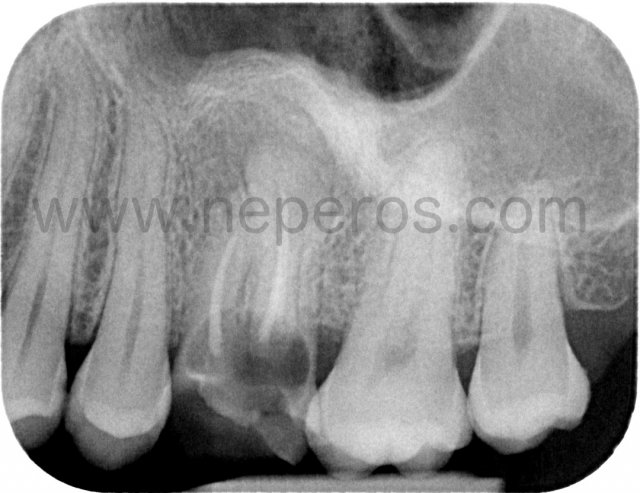 31 January 2019: tooth 26 before extraction.