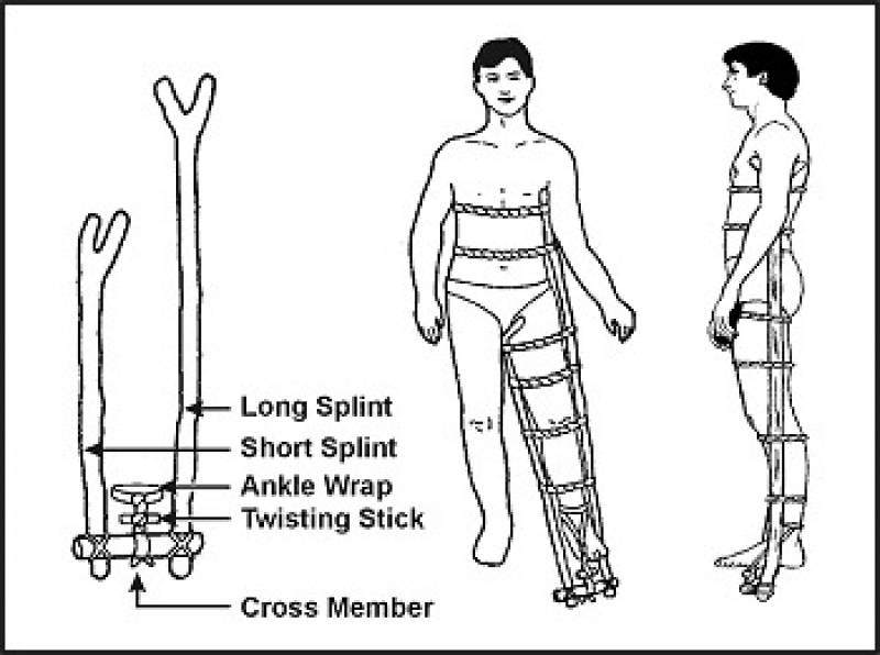 /* Figure 4-6. Improvised Traction Splint */